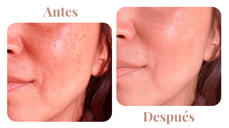 dra-carrillo-antes-y-despues-melasma-2