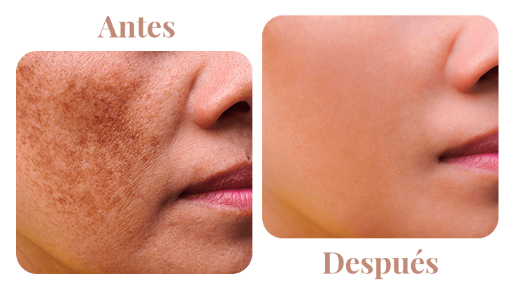 dra-carrillo-antes-y-despues-melasma